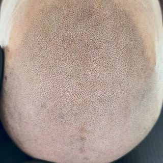 Close-up video 🙌🏼 Perfektion ligger i detaljerne. Hver impression tæller! 😍 #scalpmicropigmentati