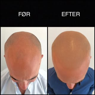 Diskret og realistisk scalp micropigmentation, der naturligt indrammer ansigtet ➡️ tilpasset hudtone