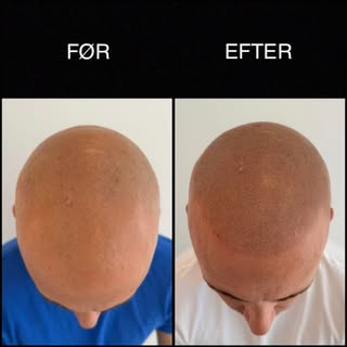 Hårtab behøver ikke at definere dit look 🙌🏼✨😍
Med scalp micropigmentation (SMP) kan du opnå et na