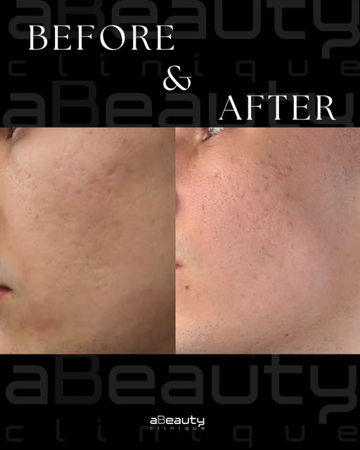 ACNE SCARS | BEFORE & AFTER ✨

Rezultat după o singură ședință de laser CO₂ fracționat: textură vizi
