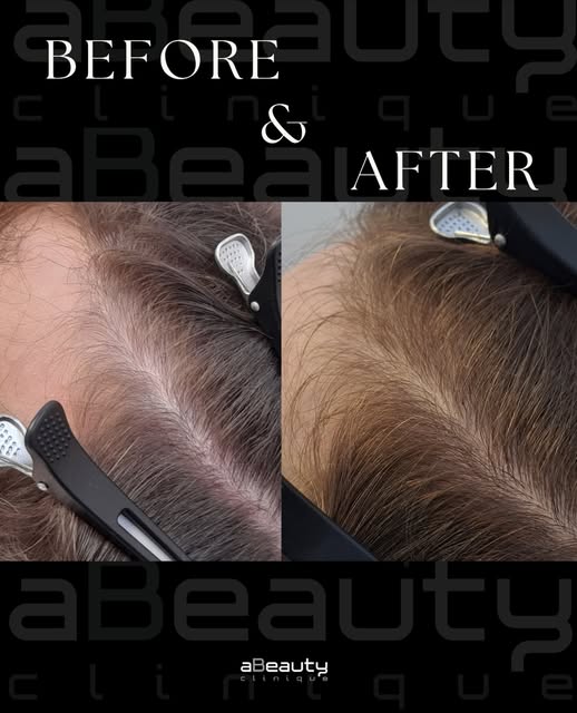 Rezultate care vorbesc de la sine ✨

Mezoterapia capilară la aBeauty Clinique: o soluție eficientă p