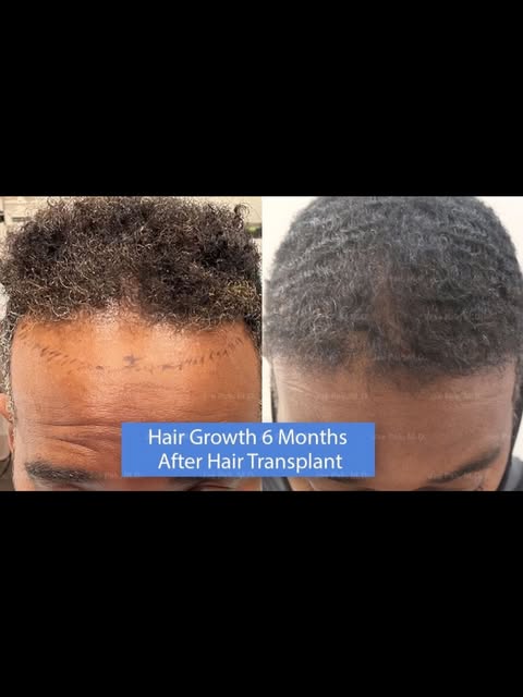 Natural results start with a plan that’s built around you. From the hairline to overall density, eve