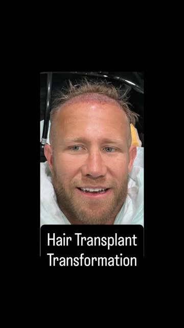 Thinning hair or a receding hairline doesn’t have to be something you just live with. A hair transpl