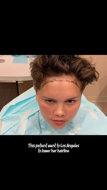 A lower hairline can make a noticeable difference in the overall proportions of the face. Hairline l