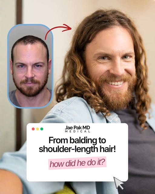 A hair transplant can make a major difference when thinning starts to change the way your hairline l