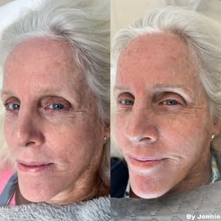 Before and healed Eyebrow Microblading.✨
One of our favorite things about microblading is how beauti