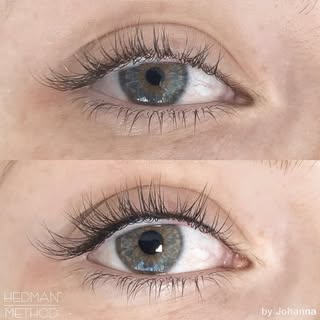 Before and after, with a result that speaks for itself. ✨

Our signature Upper Eye Enhancement is de