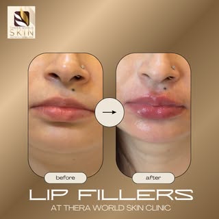 Your lips, but better. ✨ 
Book your custom filler consultation today and achieve the perfect pout🥰

