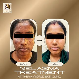 Fading the spots, revealing the glow. ✨ Advanced melasma and pigmentation treatments tailored just f