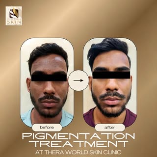 They said pigmentation won’t go.
We proved them wrong✨
Real patient. Real result. Only at Thera Worl