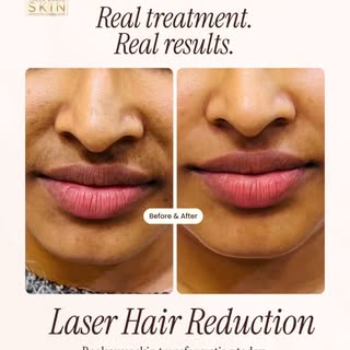 Experience smoother-looking skin with Laser Hair Reduction at Thera World Skin. Because effective sk