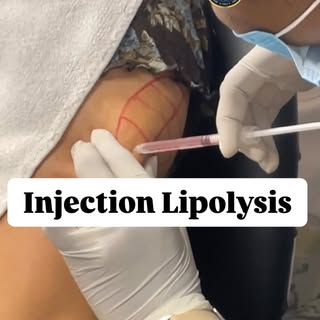 Injection lipolysis offers a minimally invasive, non-surgical alternative to liposuction for targete