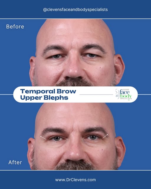 Tired of heavy, drooping eyelids? We have a solution for you.

A Temporal Brow Lift combined with Up
