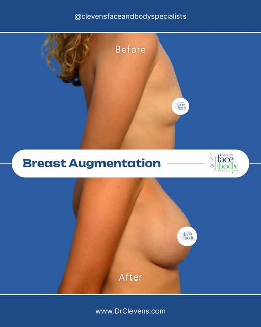 Breast Augmentation — a procedure for those who want to feel confident again!

Breasts can lose thei