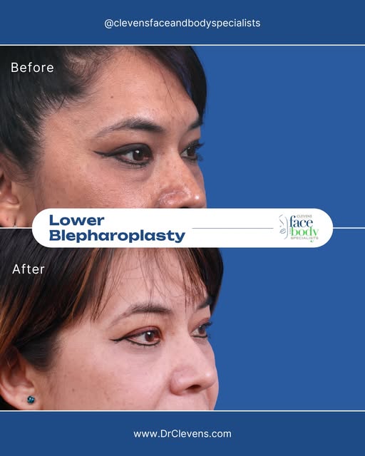 Under-Eye Bags and Dark Circles? Lower Blepharoplasty Can Help — Right Here in Florida!

This proced