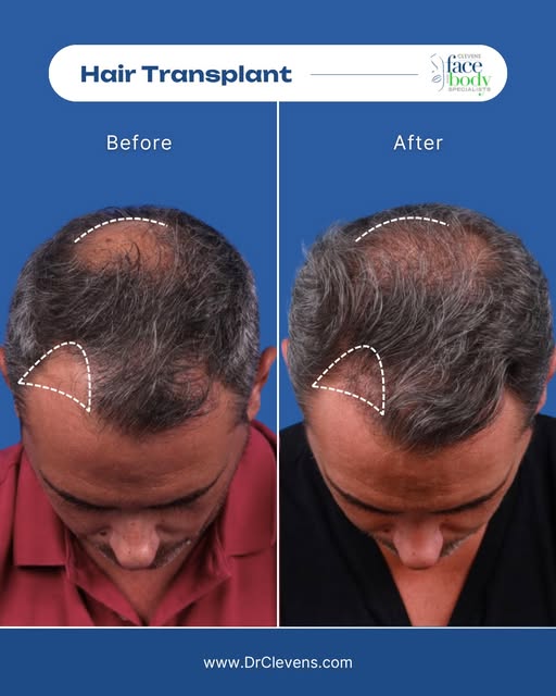 After years of living with hair loss, one decision changed everything...

Hair loss is incredibly co