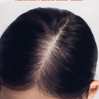 맘모스 헤어라인의원은 프라이빗한 공간에서 모발이식과 재생 치료를 함께 제공하는 탈모·항노화 특화 의료기관입니다.

모발이식센터는 대표원장 1인이 상담부터 디자인, 채취, 식모까지 