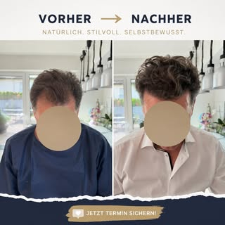 Heute zeigen wir euch das Ergebnis einer Haartransplantation, die mit der FUE-Saphir-Technik durchge
