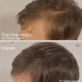 ✨ Pequeños cambios que marcan una gran diferencia.

La mesoterapia capilar ayuda a fortalecer el cab