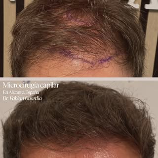 🔥 No es solo recuperar pelo. Es volver a verte como quieres verte.

Este antes y después habla por 