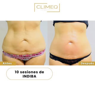 ✨ Antes y después tras 10 sesiones de Indiba Médico Elite NS en abdomen ✨

Antes: sensación de hinch