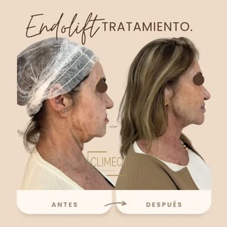 ✨ 2 meses después de Endolift ✨
Sin cirugía. Sin cambios artificiales.

Menos flacidez, más firmeza 