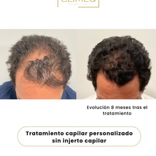 Resultados reales tras 8 meses de tratamiento capilar en CLIMEQ 😍

👉Hemos conseguido frenar la caí