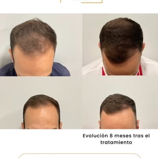 Antes y después tras 8 meses de tratamiento capilar en CLIMEQ 😍

👉 En este caso hemos conseguido f