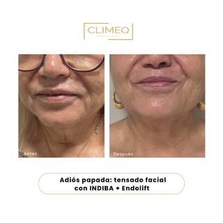 ✨ Adiós al efecto de “papada” sin cirugía ✨

En este caso conseguimos mejorar la flacidez del tercio