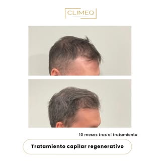 ✨ 10 meses de evolución con resultados naturales.

Antes y después de nuestro paciente tras un trata