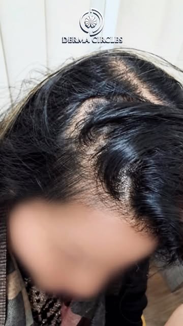 Tired of hiding your thinning crown? 👑 Say goodbye to hair loss and hello to unstoppable confidence