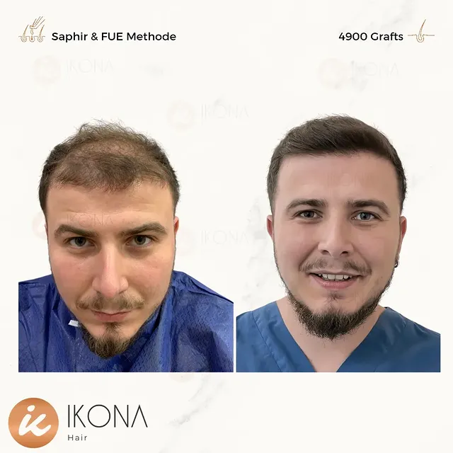☆
Natürliches Aussehen nach der Haartransplantation.

Vereinbaren Sie einen Termin zur ausführlichen