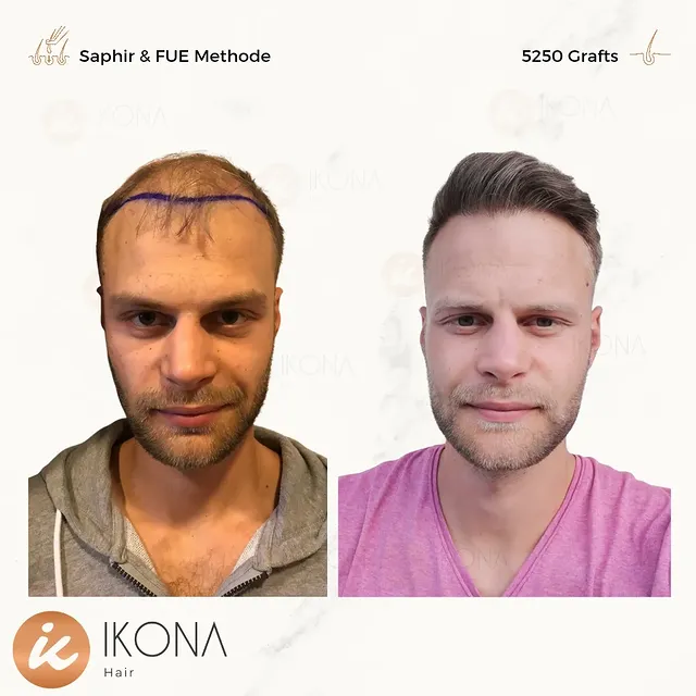 ☆
Ein Leben lang volles Haar.

Vereinbaren Sie einen Termin zur ausführlichen 
Beratung mit Haaranal