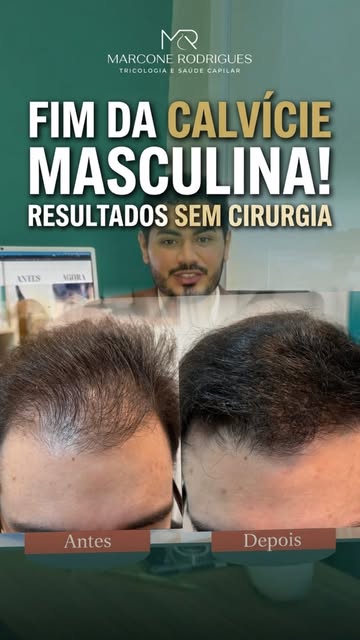 Se você percebeu que o seu cabelo está indo embora, eu posso te ajudar! 

Envia esse vídeo para aque
