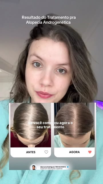 Calva? NÃO MAIS…Muito obrigada @tricologistamarcone por todo auxílio durante meu tratamento pra alop