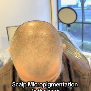Hair loss doesn’t have to define your confidence.

Scalp Micropigmentation (SMP) is one of the most 