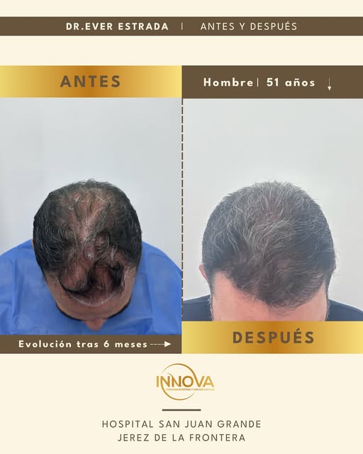 6 meses de evolución, un cambio real y natural. 😍

Recuperar tu cabello también es posible con una 