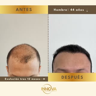 12 meses de evolución y los resultados son más que visibles. 😍

Este paciente ha recuperado densida