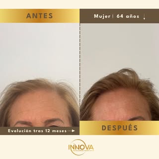 Nuestra paciente de 64 años llegó a consulta preocupada por la pérdida progresiva de densidad capila