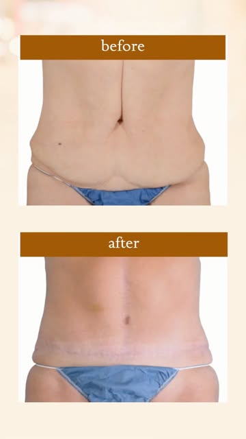 Losing a significant amount of weight is an incredible accomplishment 👏 

For many patients, it’s a