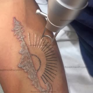 Bringing the mountains down ⛰️…… literally 🔥 

For appointments 
www.kezaclinic.com
📞 +91 99862922