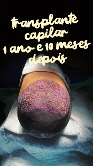 quase 2 anos de transplante capilar e eu jamais imaginei que meu cabelo estaria tão grande, e eu ama
