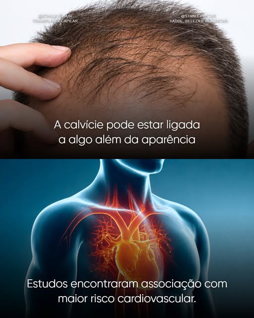 Primeiro: siga @stanleyshair e @stanleybittar.

Calvície e coração parecem assuntos completamente di