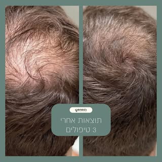 תוצאות מדהימות אחרי 3 טיפולים בלבד!
ב-Genesis Clinic, טיפולי ה-PRP שלנו מחזירים לשיער שלכם את החיוני