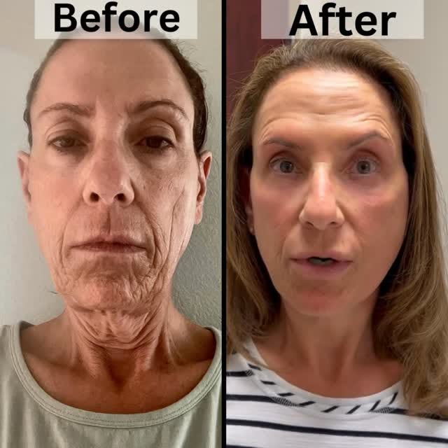 Here is this amazing Before and After Testimonial of a patient who had Bilateral Upper Lid and Bilat