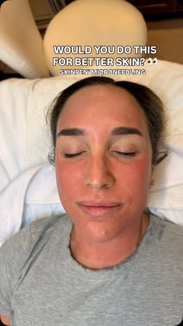 Would you do THIS for better skin? 👀🩸

It looks intense, but this is SkinPen microneedling doing i