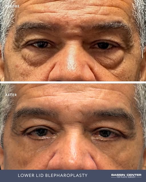 Your eyes tell your story, but heavy, tired-looking eyelids don’t always reflect how vibrant you fee