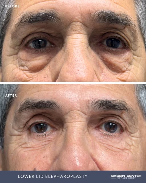 7 months later... refreshed eyes, natural results, and no visible scars. ✨

This patient is just 7 m