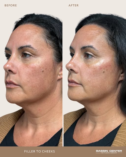 ✨ Facial balancing isn’t about changing your features, it’s about bringing them into harmony.

In th