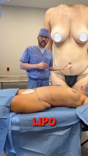 **SCULPTING AFTER A TUMMY TUCK ✨**

A tummy tuck may have already taken care of the loose skin—but s